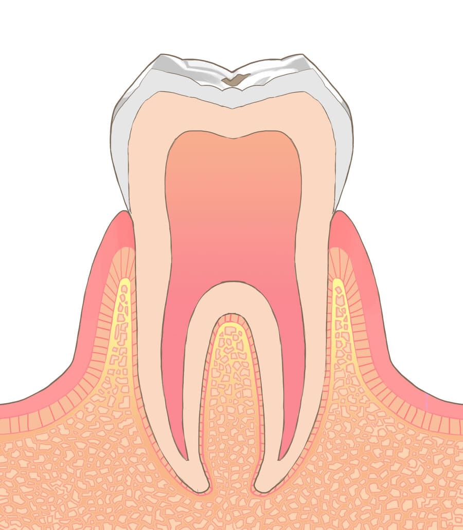 初期段階（CO）初期的な虫歯