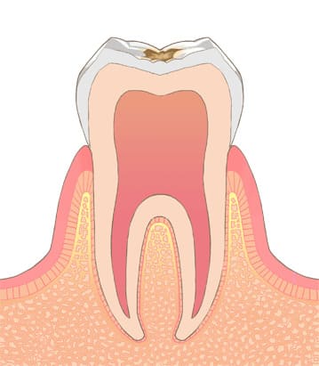 エナメル質に限局（C1）表面の虫歯