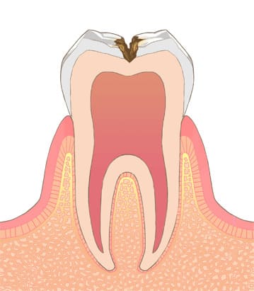 象牙質まで進行（C2）中等度の虫歯