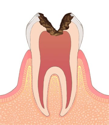 歯髄まで進行（C3）重度の虫歯