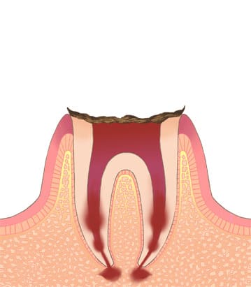 虫歯により歯の形がない状態（C4）重度の虫歯