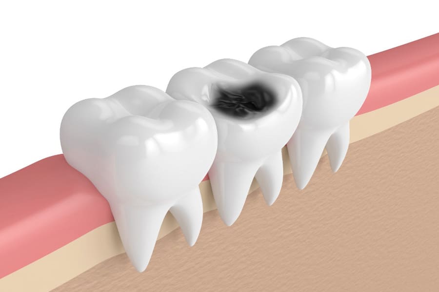 抜歯を検討する前に根管治療で天然の歯を残すことを検討しましょう